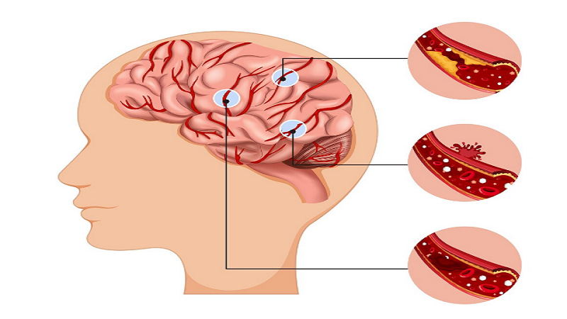 ficulititotemporal